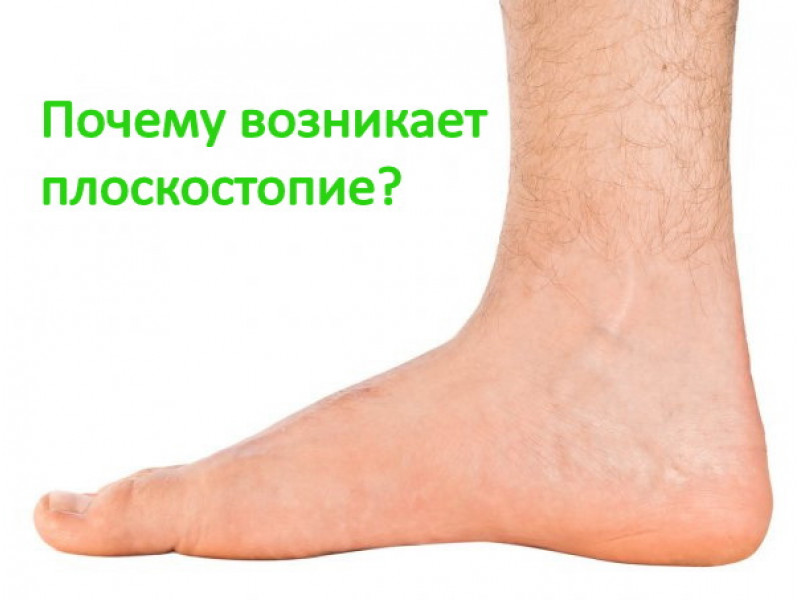 Почему возникает плоскостопие?